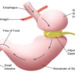 Virtual Gastric Band